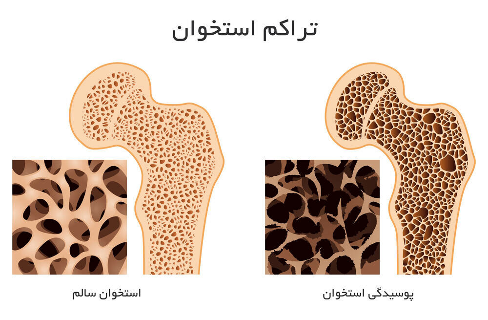 برای افزایش تراکم استخوان چه بخوریم؟/ نمونه برنامه غذایی روزانه مبتلایان به استئوپنی/ ورزشهای مناسب تراکم استخوان