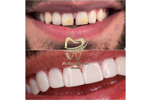 لمینت دندان جلو چگونه انجام میشود و چه مزایایی دارد؟